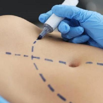 Liposuction Procedure In Riyadh
